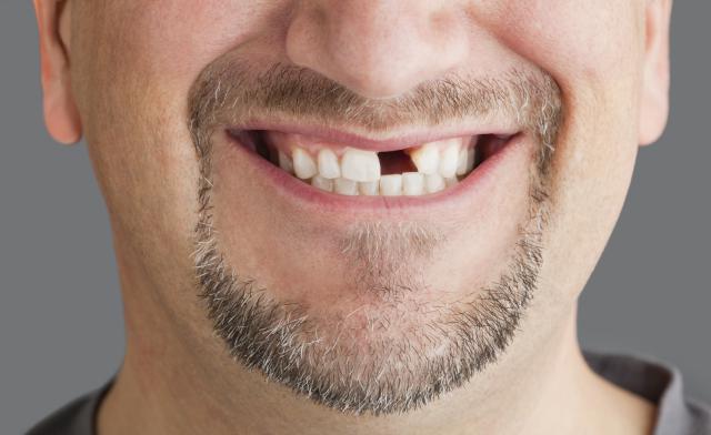 Man's mouth with missing tooth